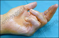 Hand - Dupuytrens